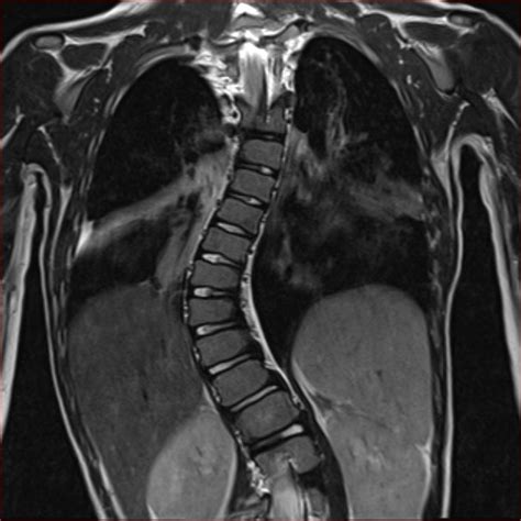 Radiologyspirit Scoliosis