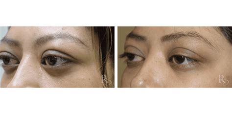 Before And After Cosmetic Eye Bulging Raymond Douglas