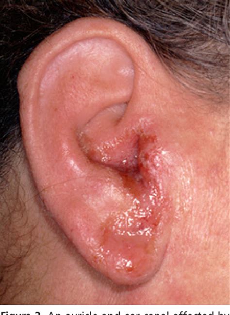 Figure 2 From Otitis Externa Review And Clinical Update Semantic