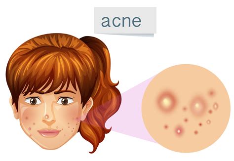 A Young Lady Acne On Face 302587 Vector Art At Vecteezy