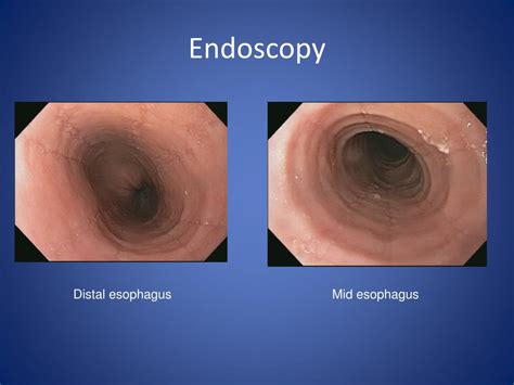 Ppt Overview Of Eosinophilic Esophagitis Powerpoint Presentation