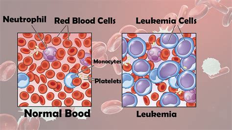 Signs Of Blood Cancers Causes Diagnosis Symptoms Treatment How To