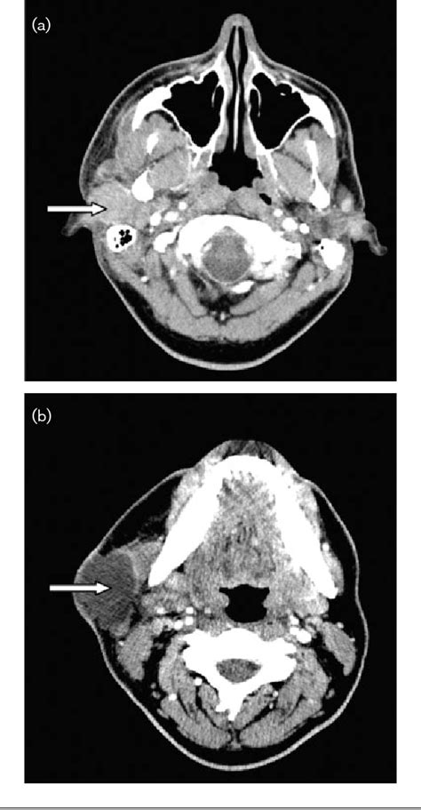 Figure 1 From Mycobacterium Avium Complex Suppurative Parotitis In A