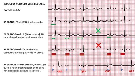️ Cómo Interpretar Un Electrocardiograma Ecg Fácil