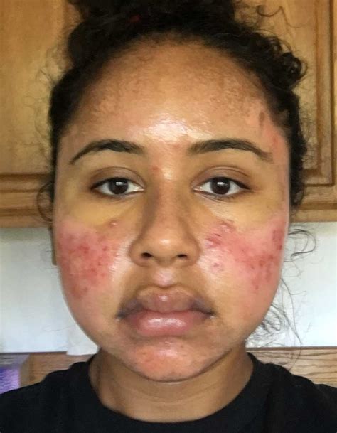 Acne Scar Vitalizer Treatment Photo Diary For African American Skin