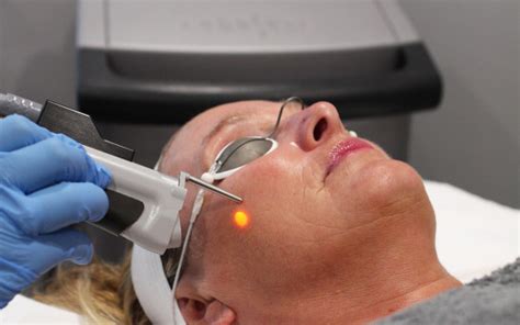 Anti Ageing Laser Treatment For Wrinkles Sure Aesthetics Dorking Horsham Crawley Surrey