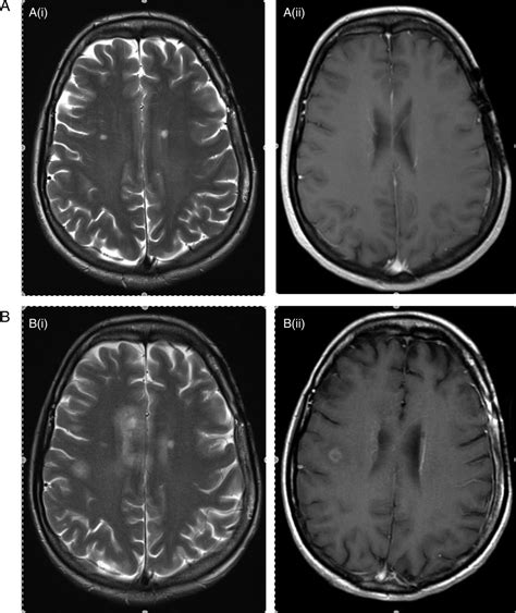 Acute Demyelination Following Radiotherapy For Glioma A Cautionary