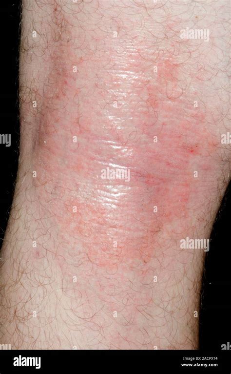 Close Up Of Red And Inflamed Skin Behind The Knee Of A 19 Year Old Male