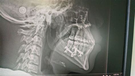 Panoramic X Ray After Corrective Jaw Surgery Corrective Jaw Surgery