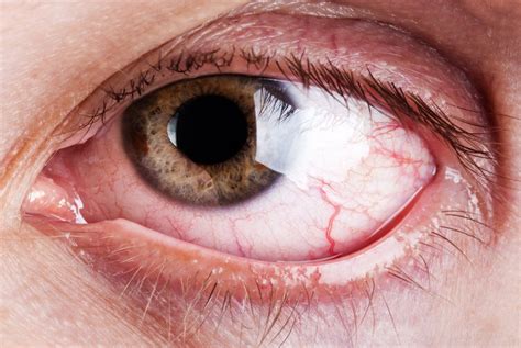 Occhio Secco Cosa Sappiamo Delle Cause Prevenzione E Cura The Eye News