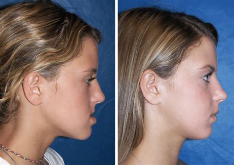 Before And After Case 12c Mandible Surgery Larry M Wolford Dmd