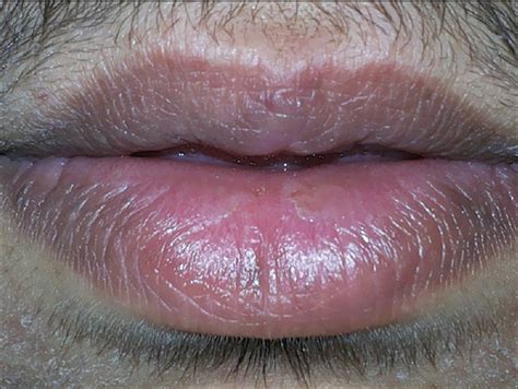 Exfoliative Cheilitis Lips