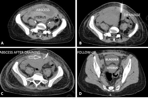 Ct Transversal Imaging Of Abscess Formation In Front Of Uterus A