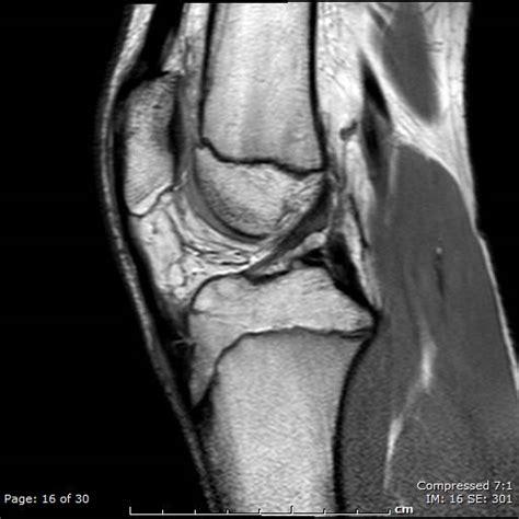 Osgood Schlatter Disease Image