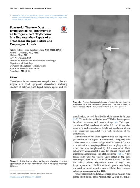 Pdf Successful Thoracic Duct Embolization For Treatment Of An