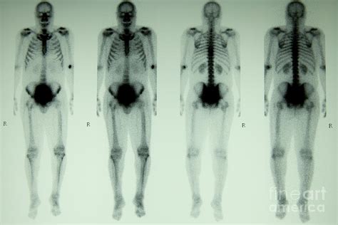 Nuclear Bone Scan Photograph By Inga Spence Pixels
