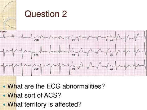 Ppt Ecg Interpretation For Beginners Part 4 Acute Coronary