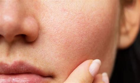 How To Get Rid Of Red Spots On Face Overnight Soulhealthlife