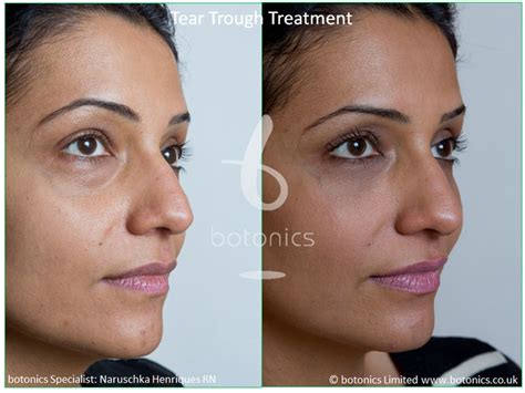 Tear Trough Fillers Before And After Pictures Botonics