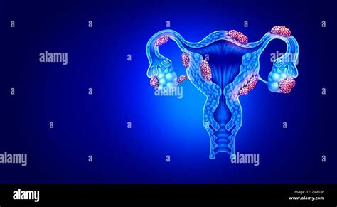 Endometriosis Disease Anatomy Concept Of Female Infertility Condition