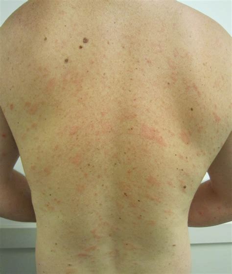 Skin Disease Types Pityriasis Rosea Skin Disease Type