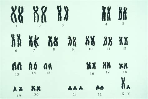 Trisomy 13 Karyotype