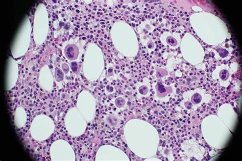 Bone Marrow Of Essential Thrombocythemia Rmedlabprofessionals
