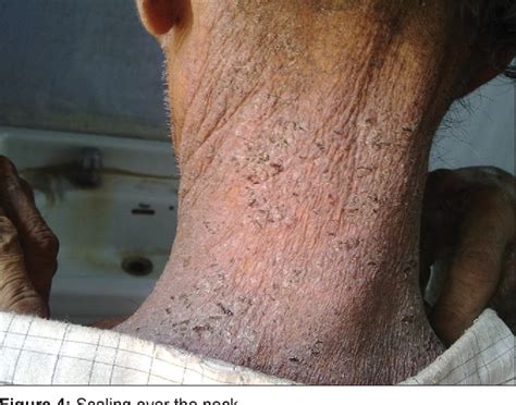 Figure 1 From Norwegian Scabies Rare Cause Of Erythroderma Semantic
