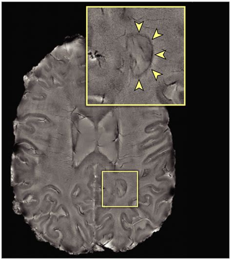 “smoldering” Brain Lesions Might Signal Severe Multiple Sclerosis