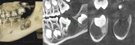Dentigerous Cyst Of The Mandible In A Child Dentigerous Cyst Of The