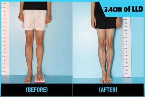 Leg Length Discrepancy Leg Lengthening Surgery Precice