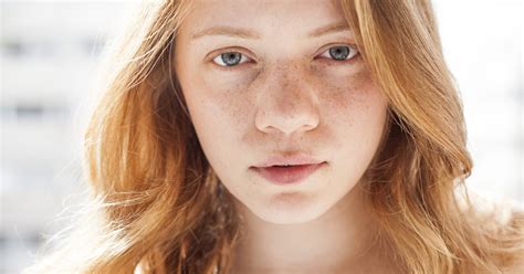Natural Ways To Get Rid Of Freckles Livestrongcom