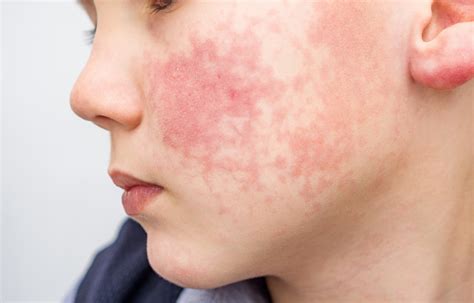 Boy With Red Cheeks Diathesis Or Allergy Symptoms Redness And Peeling