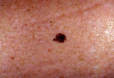 Melanocytic Naevi Moles Causes And Treatments Tibot