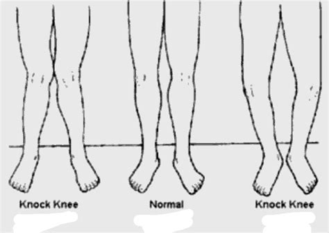 Knock Knees Test Check Yourself At Home