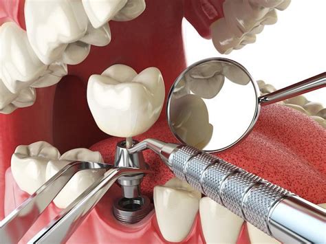 Are You A Candidate For Dental Implants Pacific Oral And Maxillofacial