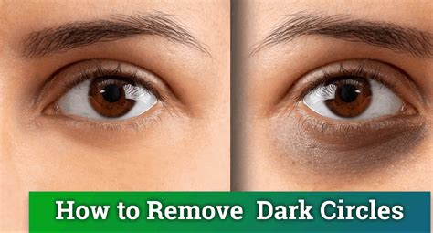 10 Natural Ways To Get Rid Of Dark Circles Under Eyes