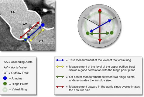 Standardized Imaging For Aortic Annular Sizing Implications For