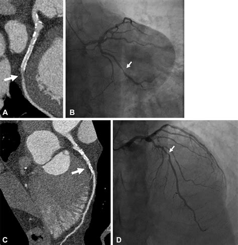 Ultra High Resolution Coronary CT Angiography For Assessment Of Patients With Severe Coronary