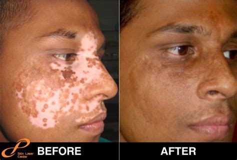 White Patches Or Vitiligo Is Common But After Sometimes It Make Part
