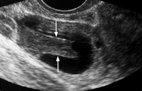 Hemorrhagic Corpus Luteal Cyst In A 25 Year Old Woman Transvaginal