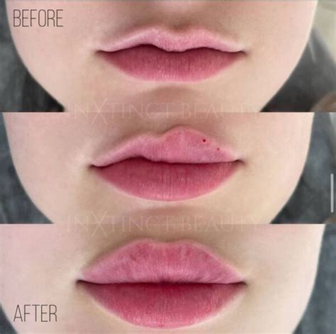 Russian Lip Technique Lip Augmentation Lip Filler Nyc