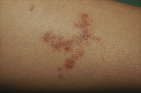 Violaceous Purpuric Plaques On The Lower Extremity—quiz Case Allergy