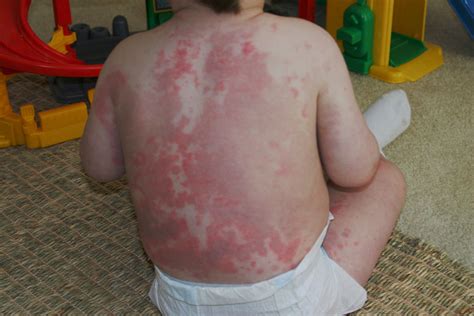 Erythema Multiforme Types Symptoms Causes Diagnosis And Treatment