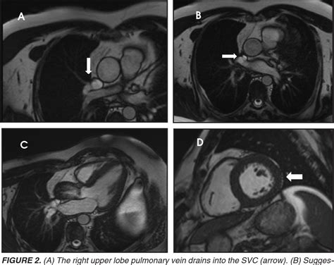 Figure 2 From Mri In The Assessment Of Congenital Heart Disease