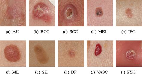Primary skin lesions originate on previously healthy skin and are directly associated. Figure 1 from Hierarchical Classification of Ten Skin ...