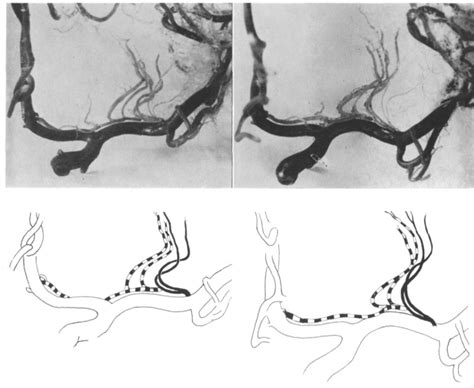 Figure 2 From The Recurrent Artery Of Heubner And The Arteries Of The