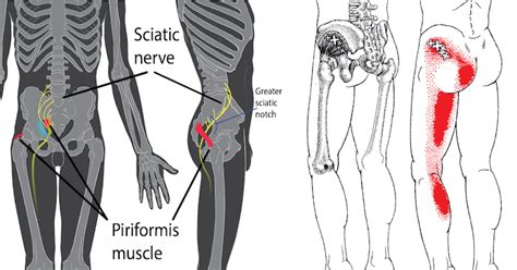 Piriformis Syndrome After Hip Replacement Sangstreat
