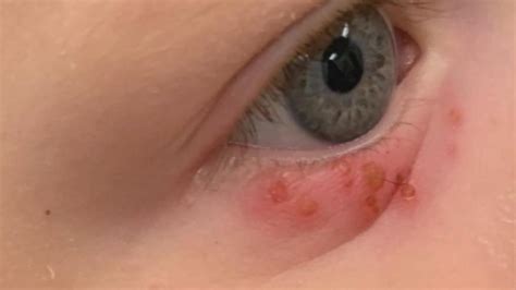 Herpes Virus Threatens Eyesight Wsav Tv