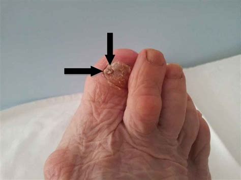 Treatment Subungual Melanoma In Foot Case Report • New Medicine 3